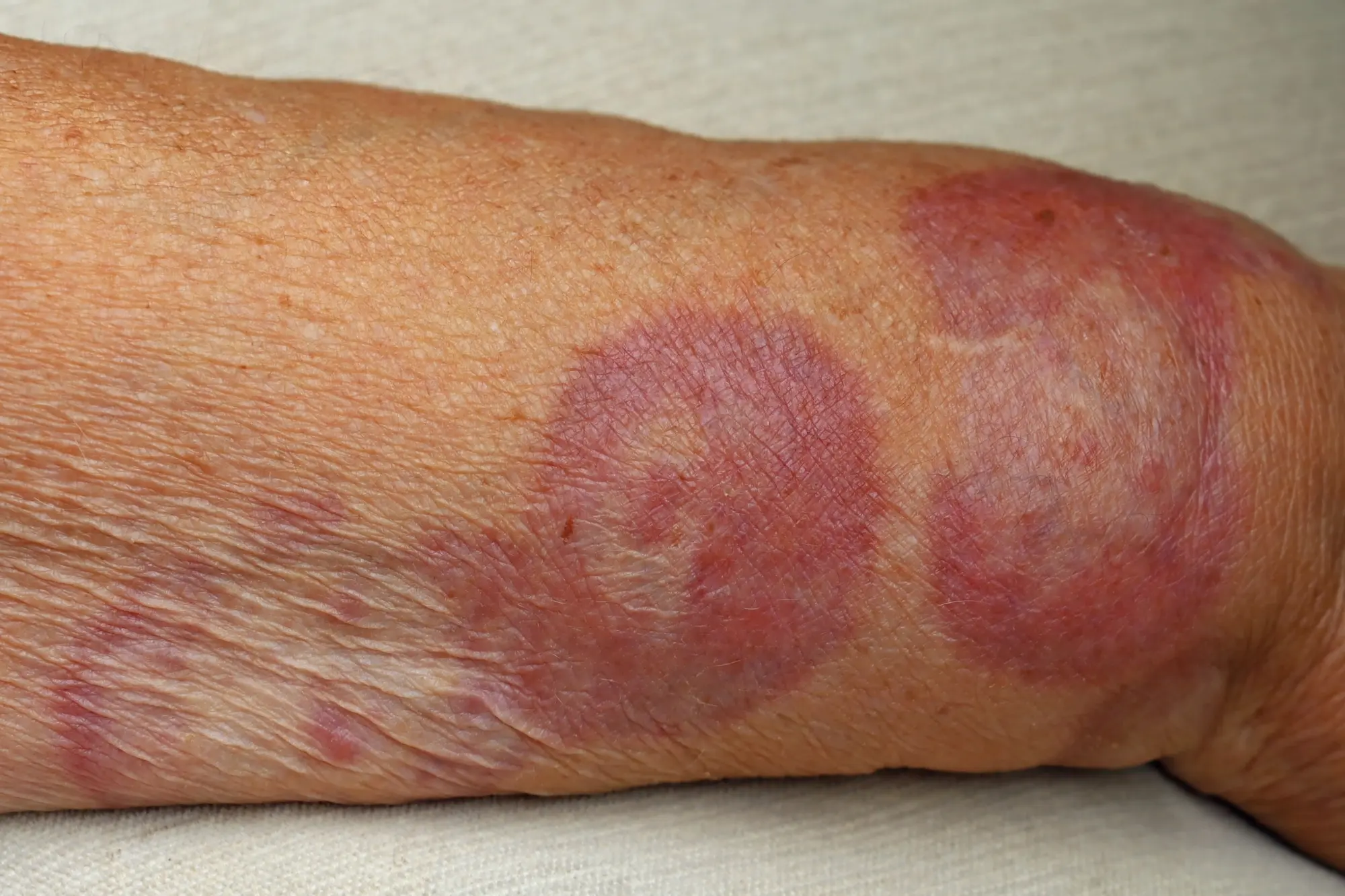An Example of Granuloma Annulare